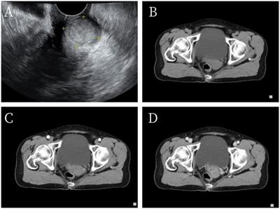 Case report: Multiphenotypic cervical cancer resembling human papillomavirus-related multiphenotypic sinonasal carcinoma